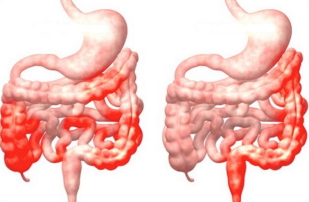 viêm ruột cấp tính